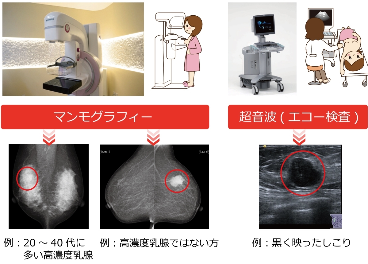 マンモグラフィ検査とエコー（超音波）検査、どちらを受けたほうがいいの？