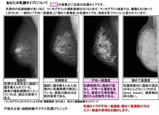 マンモグラフィ 社会医療法人仁厚会