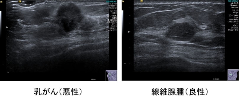 音波 乳腺 検査 超 マンモグラフィーと超音波(エコー)検査はどちらを受ければ良い？